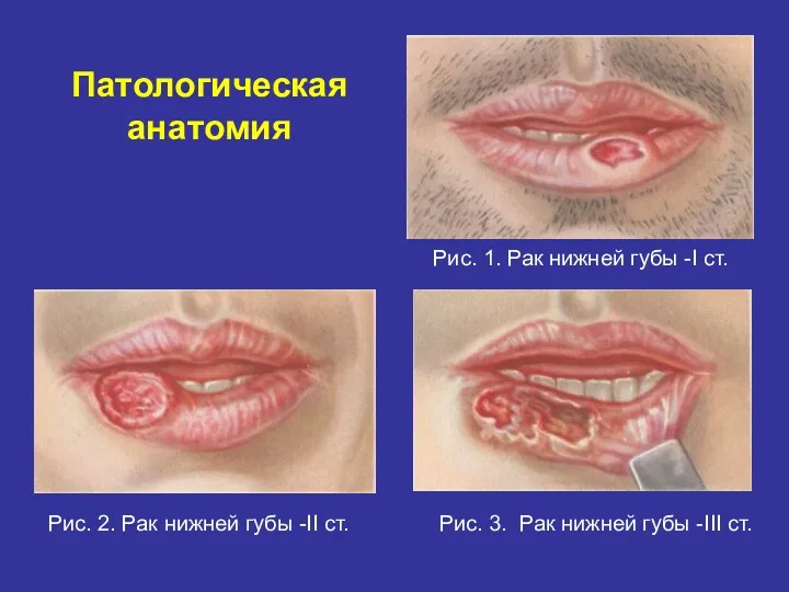 Патологическая анатомия Рис. 1. Рак нижней губы -I ст. Рис. 2. Рак нижней