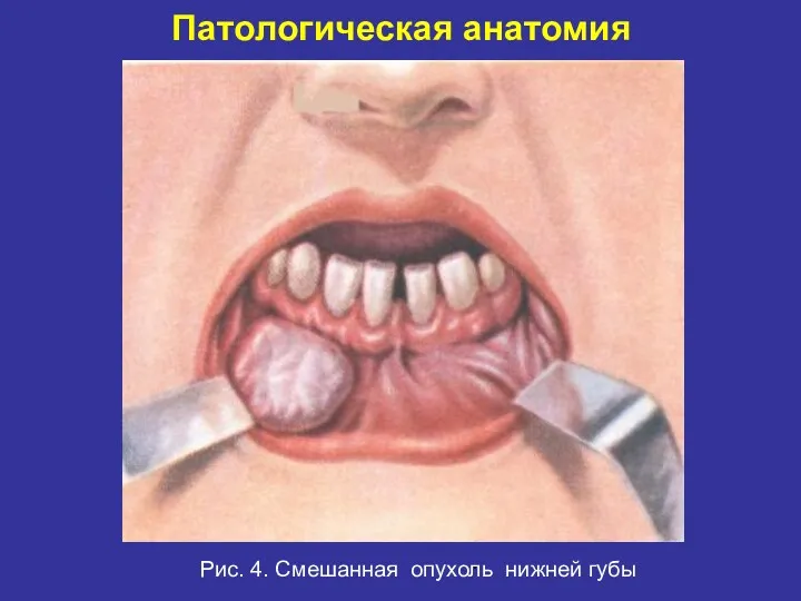 Патологическая анатомия . Рис. 4. Смешанная опухоль нижней губы
