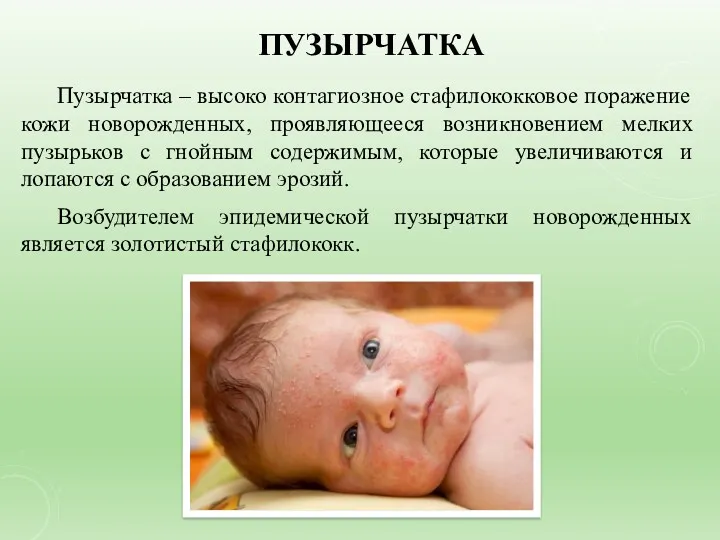 ПУЗЫРЧАТКА Пузырчатка – высоко контагиозное стафилококковое поражение кожи новорожденных, проявляющееся возникновением мелких пузырьков