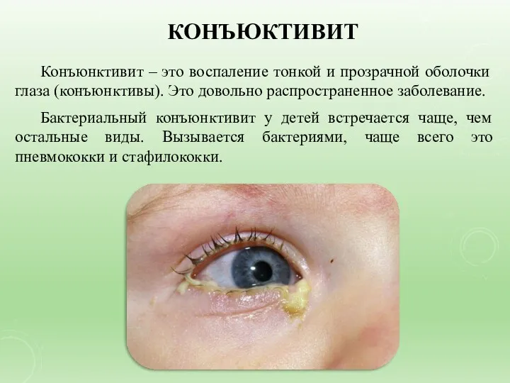 КОНЪЮКТИВИТ Конъюнктивит – это воспаление тонкой и прозрачной оболочки глаза (конъюнктивы). Это довольно