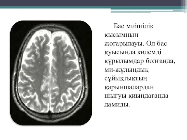 Бас миішілік қысымның жоғарылауы. Ол бас қуысында көлемді құрылымдар болғанда, ми-жұлындық сұйықтықтың қарыншалардан шығуы қиындағанда дамиды.