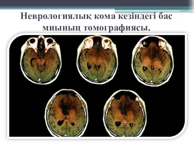 Неврологиялық кома кезіндегі бас миының томографиясы.