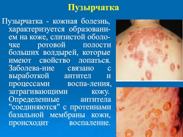 Пузырчатка Пузырчатка - кожная болезнь, характеризуется образовани-ем на коже, слизистой