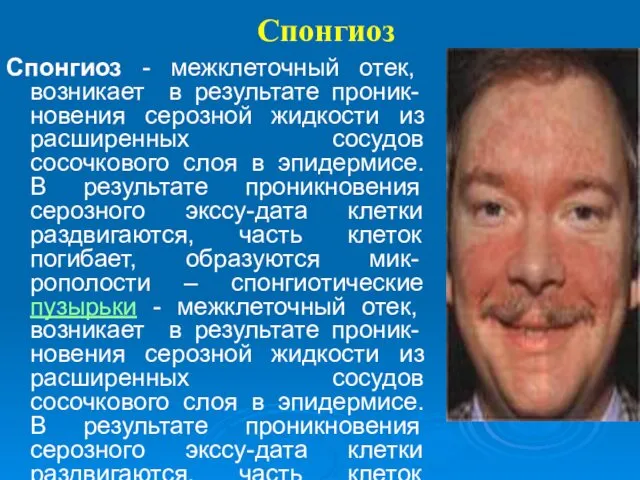 Спонгиоз Спонгиоз - межклеточный отек, возникает в результате проник-новения серозной