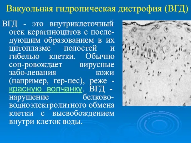 Вакуольная гидропическая дистрофия (ВГД) ВГД - это внутриклеточный отек кератиноцитов