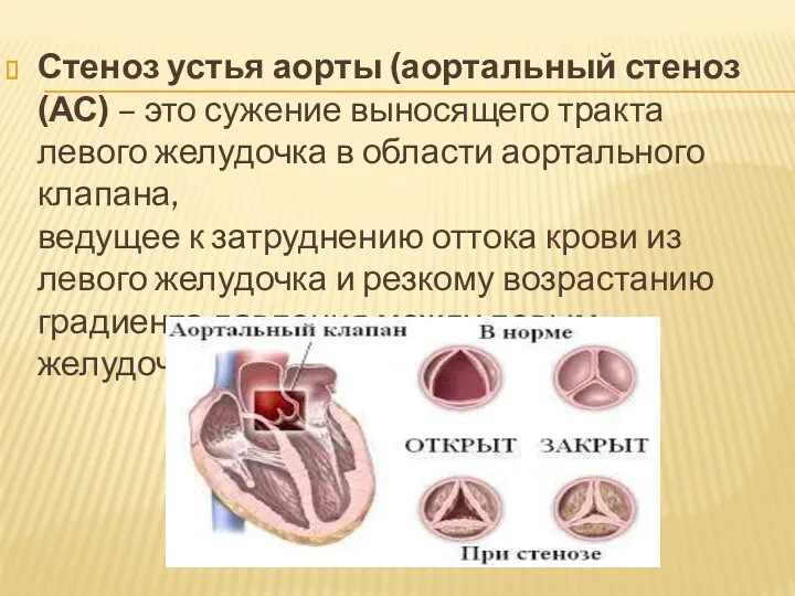 Стеноз устья аорты (аортальный стеноз (АС) – это сужение выносящего