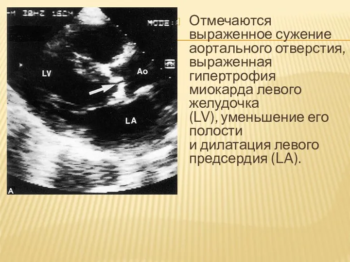 Отмечаются выраженное сужение аортального отверстия, выраженная гипертрофия миокарда левого желудочка