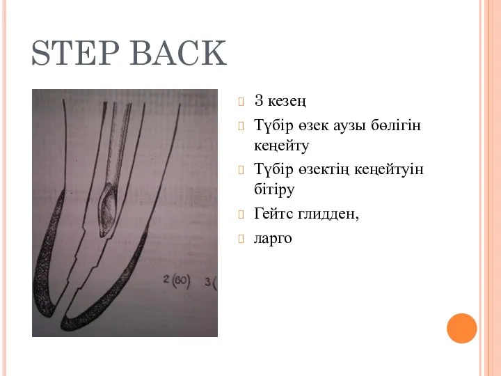 STEP BACK 3 кезең Түбір өзек аузы бөлігін кеңейту Түбір өзектің кеңейтуін бітіру Гейтс глидден, ларго