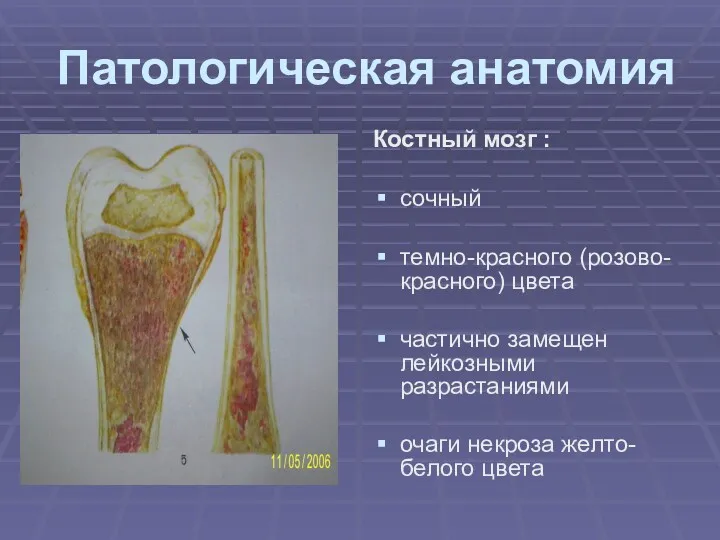 Патологическая анатомия Костный мозг : сочный темно-красного (розово-красного) цвета частично