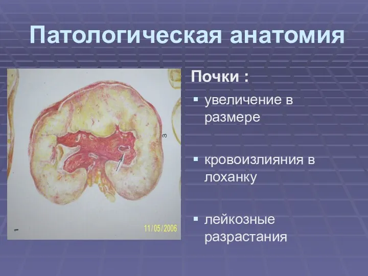 Патологическая анатомия Почки : увеличение в размере кровоизлияния в лоханку лейкозные разрастания