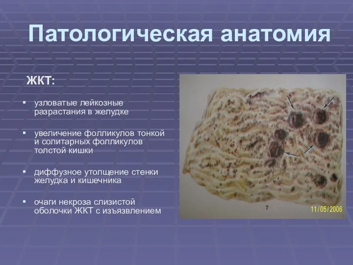 Патологическая анатомия ЖКТ: узловатые лейкозные разрастания в желудке увеличение фолликулов