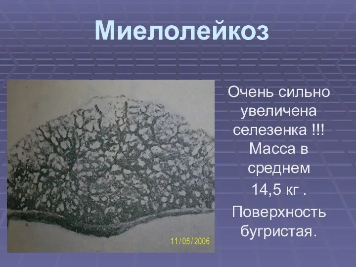 Миелолейкоз Очень сильно увеличена селезенка !!! Масса в среднем 14,5 кг . Поверхность бугристая.