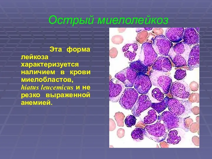 Острый миелолейкоз Эта форма лейкоза характеризуется наличием в крови миелобластов,