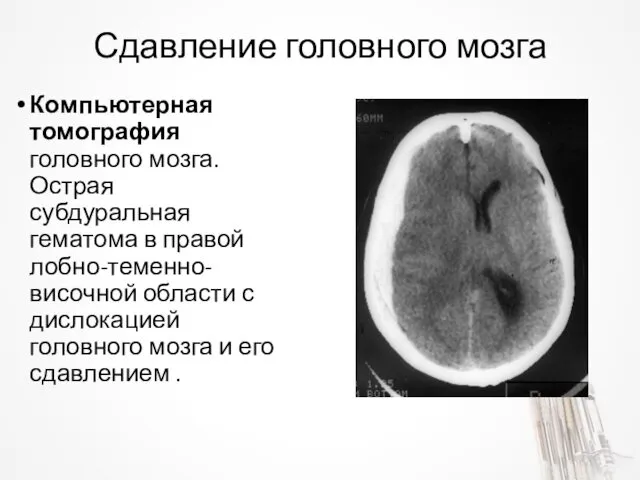 Сдавление головного мозга Компьютерная томография головного мозга. Острая субдуральная гематома
