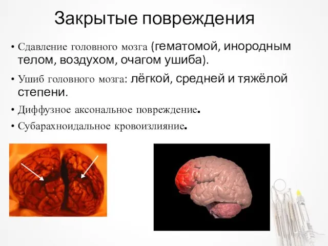 Закрытые повреждения Сдавление головного мозга (гематомой, инородным телом, воздухом, очагом