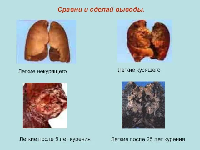 Сравни и сделай выводы. Легкие некурящего Легкие курящего Легкие после