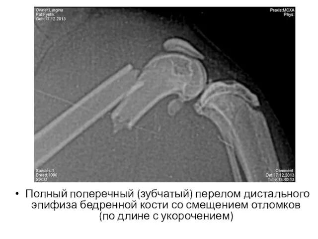 Полный поперечный (зубчатый) перелом дистального эпифиза бедренной кости со смещением отломков (по длине с укорочением)