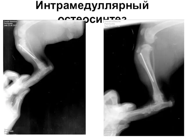 Интрамедуллярный остеосинтез