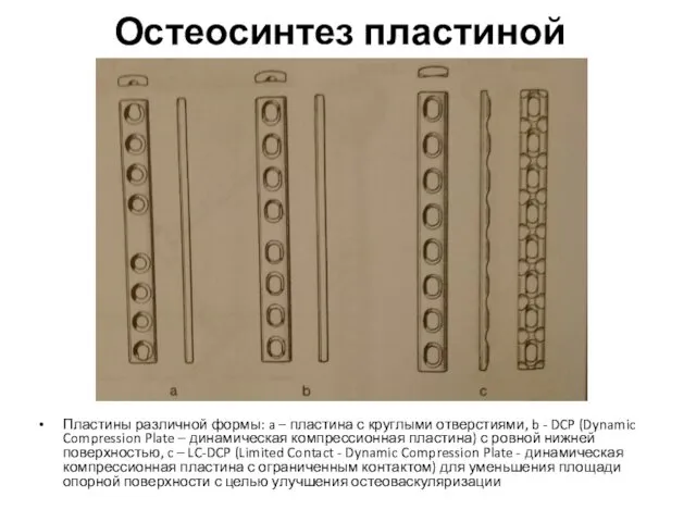 Остеосинтез пластиной Пластины различной формы: a – пластина с круглыми