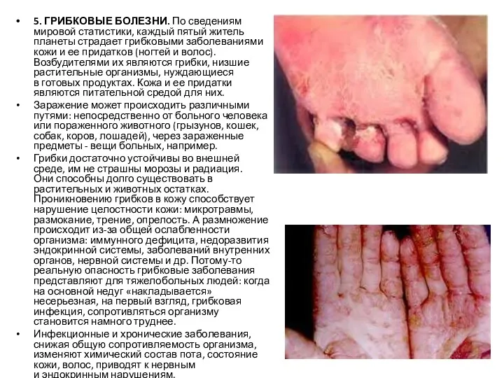 5. ГРИБКОВЫЕ БОЛЕЗНИ. По сведениям мировой статистики, каждый пятый житель