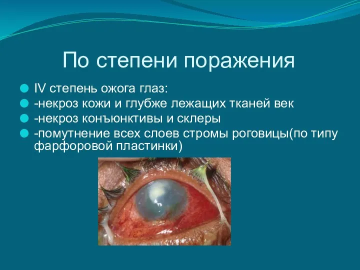 По степени поражения IV степень ожога глаз: -некроз кожи и
