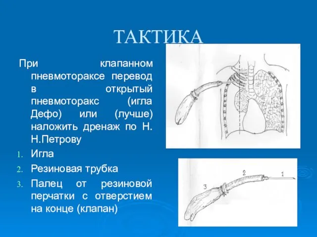 ТАКТИКА При клапанном пневмотораксе перевод в открытый пневмоторакс (игла Дефо)