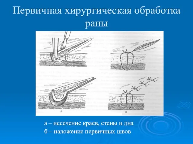 Первичная хирургическая обработка раны а – иссечение краев, стены и дна б – наложение первичных швов