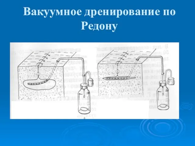 Вакуумное дренирование по Редону