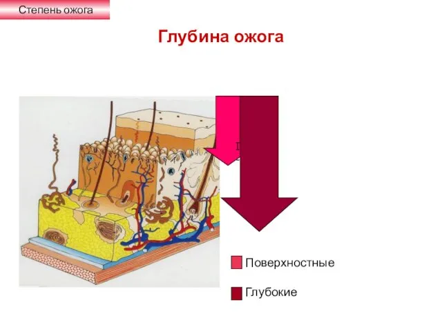 Глубина ожога I- Поверхностные Глубокие Степень ожога