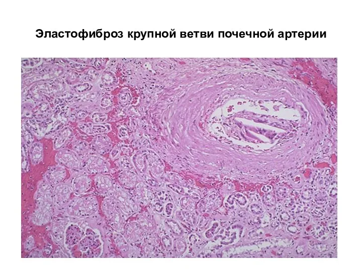 Эластофиброз крупной ветви почечной артерии