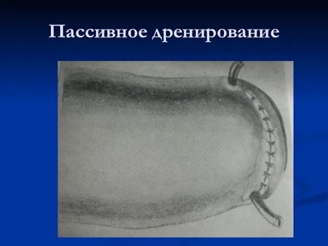 Пассивное дренирование