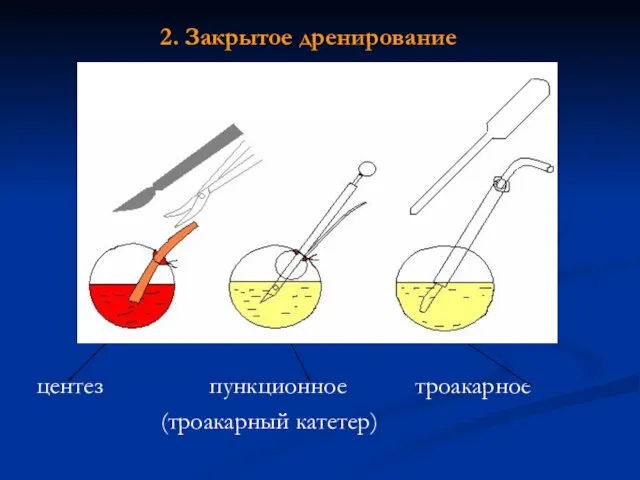 2. Закрытое дренирование центез пункционное троакарное (троакарный катетер)