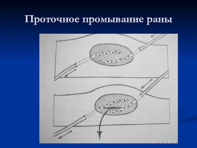 Проточное промывание раны