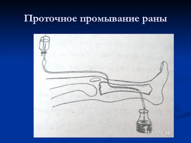 Проточное промывание раны