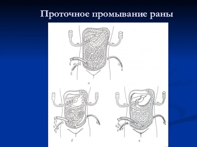 Проточное промывание раны