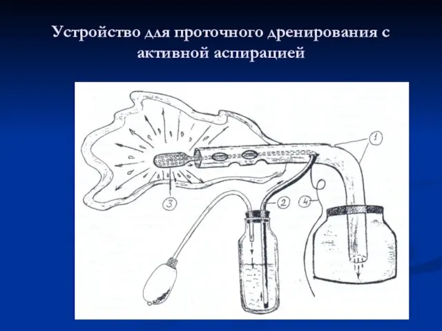 Устройство для проточного дренирования с активной аспирацией