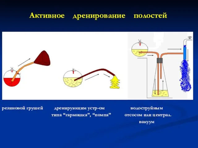 Активное дренирование полостей резиновой грушей дренирующим устр-ом водоструйным типа “гармошка”, “помпа” отсосом или централ. вакуум