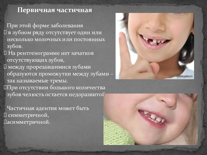 Первичная частичная При этой форме заболевания в зубном ряду отсутствует