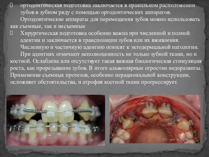 ортодонтическая подготовка заключается в правильном расположении зубов в зубном ряду