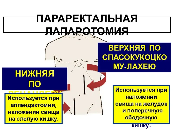 ВЕРХНЯЯ ПО СПАСОКУКОЦКОМУ-ЛАХЕЮ НИЖНЯЯ ПО ЛЕНАНДЕРУ Используется при аппендэктомии, наложении