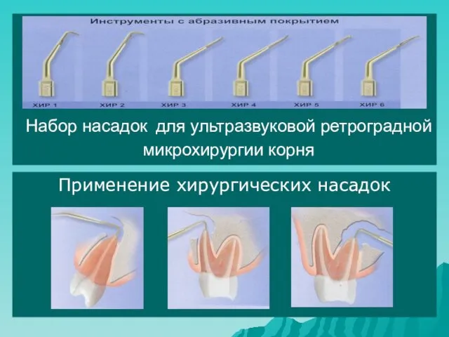 Набор насадок для ультразвуковой ретроградной микрохирургии корня Применение хирургических насадок