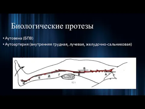 Биологические протезы Аутовена (БПВ) Аутоартерия (внутренняя грудная, лучевая, желудочно-сальниковая)