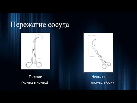 Пережатие сосуда Полное Неполное (конец в конец) (конец в бок)