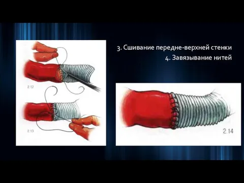 3. Сшивание передне-верхней стенки 4. Завязывание нитей