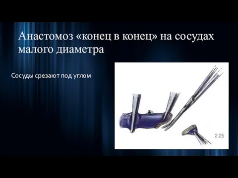 Анастомоз «конец в конец» на сосудах малого диаметра Сосуды срезают под углом