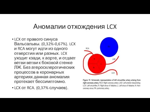 Аномалии отхождения LCX LCX от правого синуса Вальсальвы. (0,32%-0,67%). LCX и RCA могут