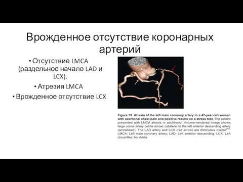 Врожденное отсутствие коронарных артерий Отсутствие LMCA (раздельное начало LAD и LCX). Атрезия LMCA Врожденное отсутствие LCX