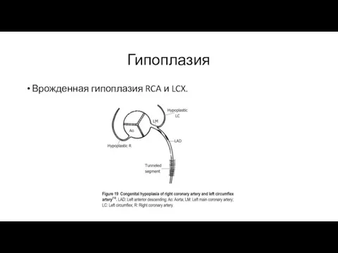 Гипоплазия Врожденная гипоплазия RCA и LCX.