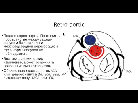 Retro-aortic Позади корня аорты. Проходит в пространстве между задним синусом Вальсальвы и межпредсердной