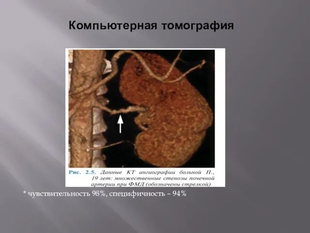 Компьютерная томография * чувствительность 98%, специфичность – 94%